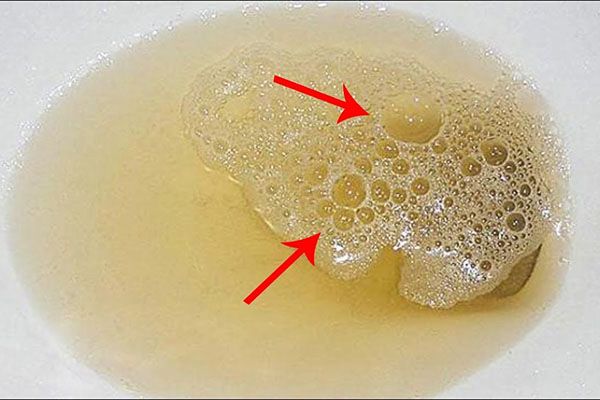 Đi ngoài ra bọt là bệnh lý gì? Có nguy hiểm không?