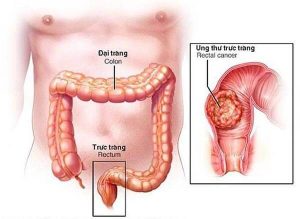 Bị táo bón đi ngoài ra máu tươi nguy hiểm đến mức nào? 