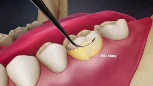 Chảy máu chân răng không ngừng là bệnh gì? Nguy hiểm không? 