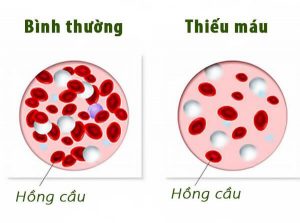 Chảy máu cam kèm đau đầu, ù tai – Cảnh giác ung thư mũi họng!