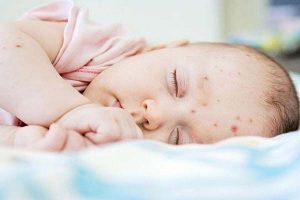 Trẻ sơ sinh bị nóng trong người phải làm sao? Cách khắc phục 