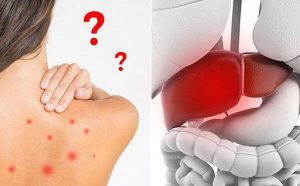 Dấu hiệu nhận biết nóng trong người và cách điều trị nóng trong