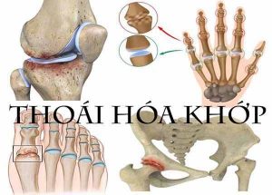Thoái hóa khớp là gì? Triệu chứng, nguyên nhân gây bệnh