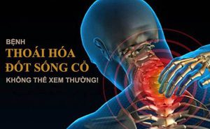 Thoái hóa đốt sống cổ có nguy hiểm không? Biến chứng đe dọa
