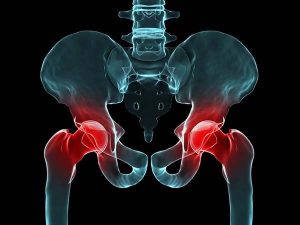 Bệnh thoái hóa khớp háng là gì? Triệu chứng và cách điều trị 