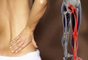 Nhận biết triệu chứng đau thần kinh tọa