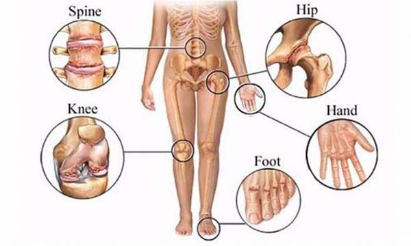 Bệnh thoái hóa đa khớp là gì? Điều trị thoái hóa đa khớp 