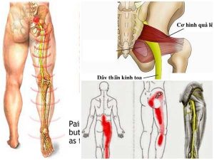 Bệnh đau thần kinh tọa: Nguyên nhân, triệu chứng, cách đẩy lùi hiệu quả