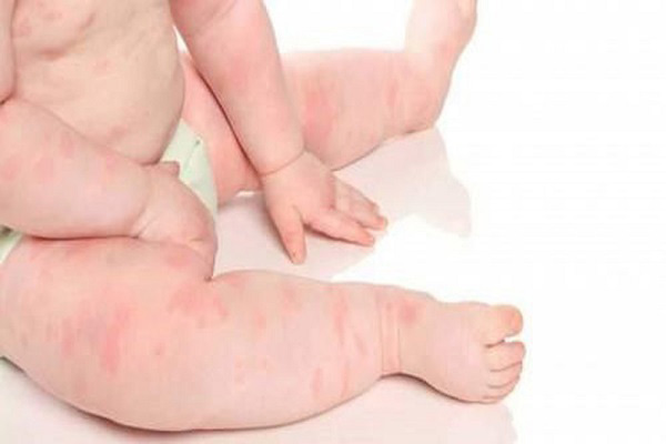 Bé bị nổi mề đay khắp người - Cách chữa nổi mề đay ở trẻ nhỏ