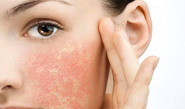 Dị ứng nổi mề đay nên kiêng gì? Thực phẩm bị mề đay nên ăn