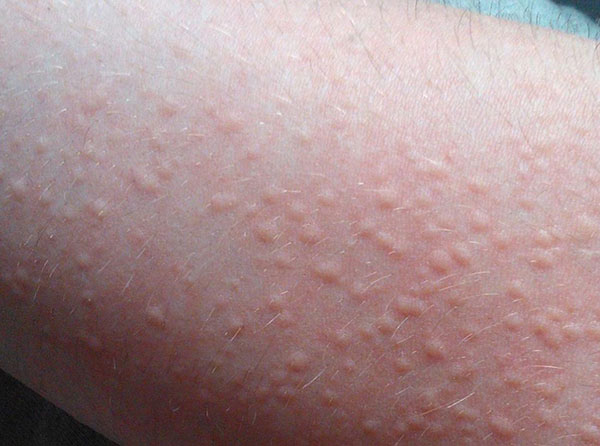 Bệnh nổi mề đay có lây không? Bệnh có di truyền không?