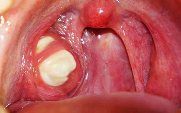 Viêm amidan hốc mủ kiêng ăn gì? Bị viêm amidan nên ăn gì?