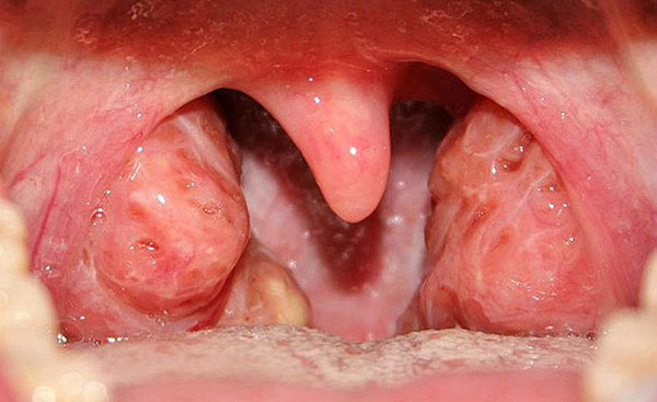 Cách chữa viêm amidan mãn tính dứt điểm mọi triệu chứng