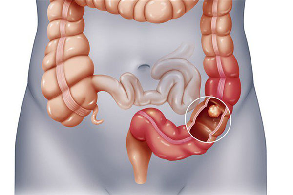 Bệnh trĩ ngoại, trĩ nội có nguy hiểm không? Tác hại của trĩ