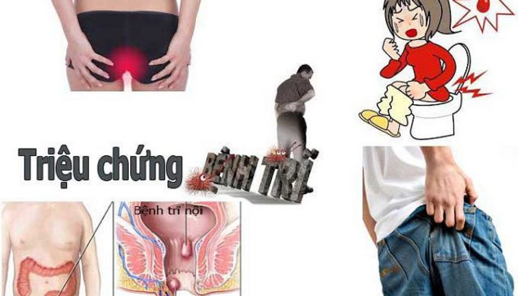 Nguyên nhân gây trĩ hỗn hợp là gì? Cách chăm sóc và điều trị bệnh