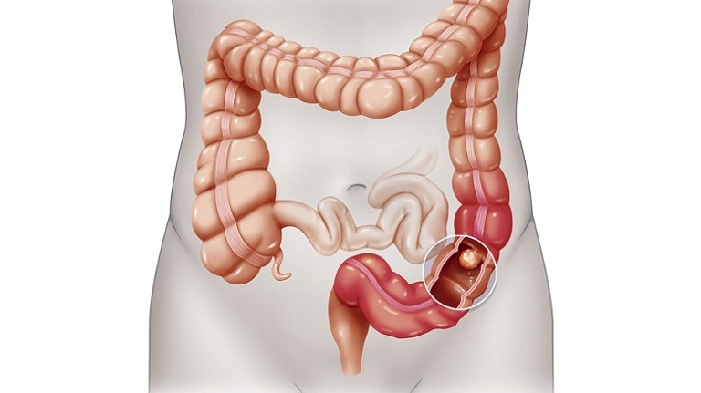 Tìm hiểu về bệnh viêm đại tràng sigma nhiều người mắc phải