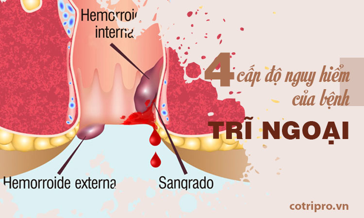 Bệnh trĩ ngoại là bệnh lý gì? Nguyên nhân, cách điều trị
