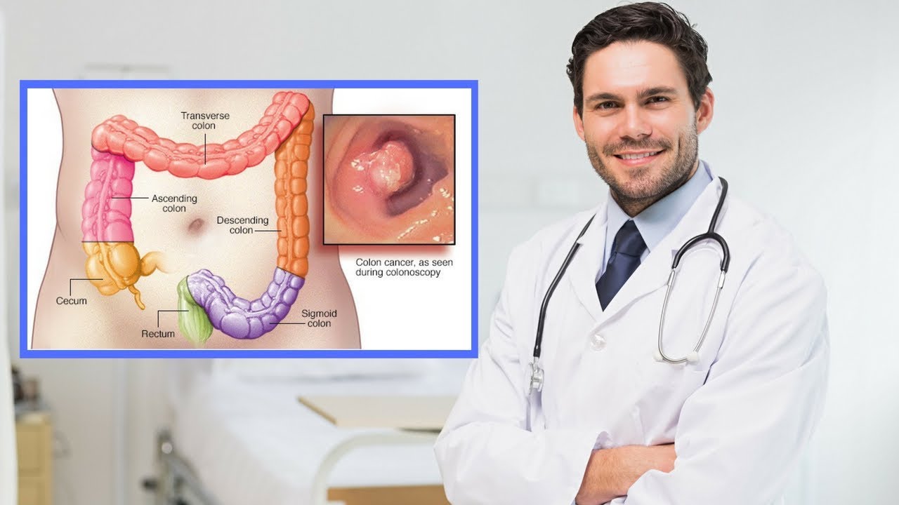 Viêm đại tràng co thắt mãn tính là bệnh lý gì mà nhiều người lo lắng?