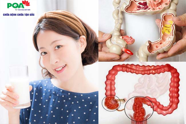Viêm đại tràng có nên uống sữa không? Chọn sữa sao cho đúng?