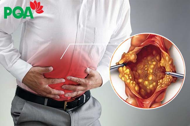 Viêm đại tràng giả mạc và những biến chứng không thể bỏ qua