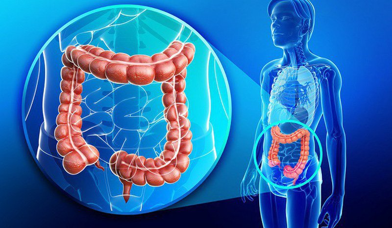 Bệnh viêm đại tràng là gì? Nguyên nhân, biểu hiện và cách điều trị