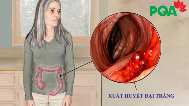 Xuất huyết đại tràng - Biến chứng nguy hiểm không thể bỏ qua