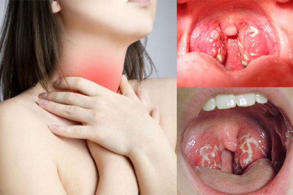 Viêm amidan quá phát mãn tính, cấp độ 3 có nguy hiểm không?