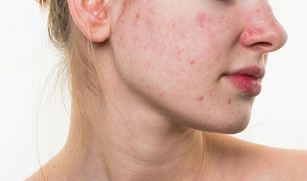 Nóng trong người nổi mẩn đỏ ảnh hưởng đến cuộc sống của bạn? xem ngay