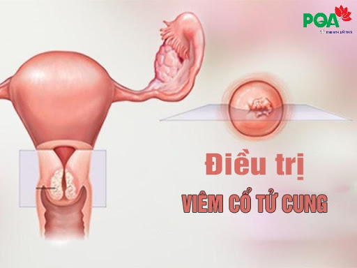 Phương pháp điều trị viêm cổ tử cung triệt để cho chị em