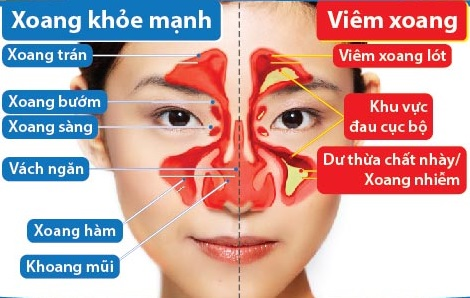 Viêm xoang mãn tính là gì? Chữa viêm xoang mãn tính có khó không?