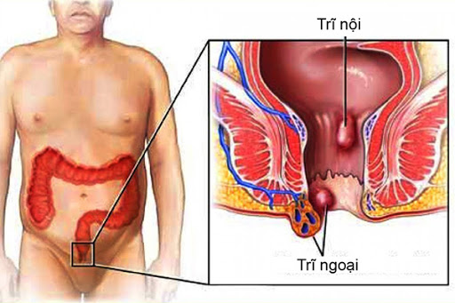 Tổng hợp các cách chữa bệnh trĩ ngoại bằng thuốc Nam và Đông Y hay nhất