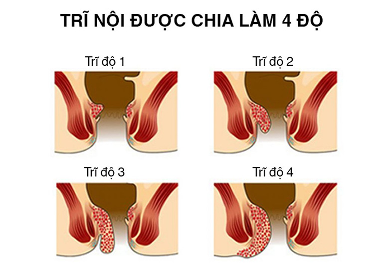 Cách chữa bệnh trĩ nội độ 1, độ 2, độ 3 hiệu quả và an toàn