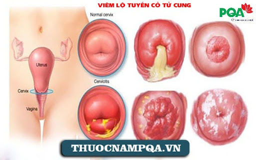 Triệu chứng viêm lộ tuyến cổ tử cung chuẩn xác: Chị em thường dễ bỏ qua