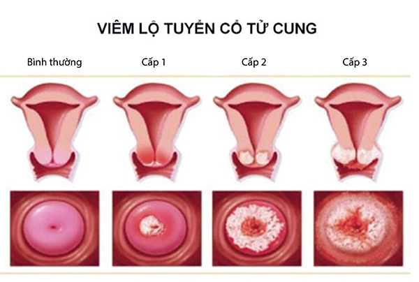 Viêm lộ tuyến cổ tử cung là gì? Nguyên nhân, biểu hiện và cách phòng ngừa bệnh