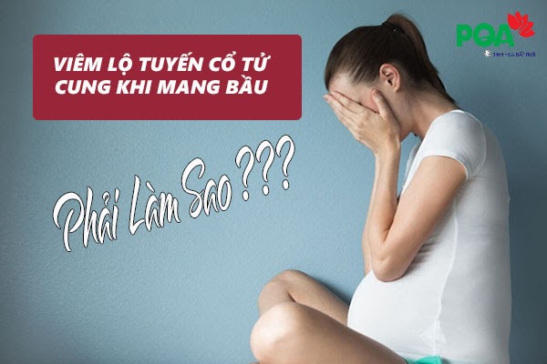 Viêm lộ tuyến cổ tử cung khi mang thai: Dấu hiệu, nguyên nhân và cách chữa