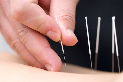 Bệnh Parkinson có nên châm cứu không? Cần lưu ý gì?