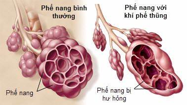 Khí phế thũng là gì? Nguyên nhân, triệu chứng và điều trị