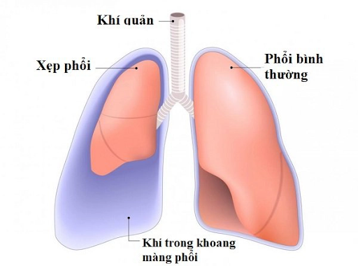 Tràn khí màng phổi: Nguyên nhân, triệu chứng và cách điều trị