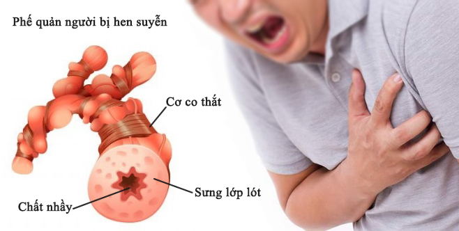 Hen phế quản là gì? Nguyên nhân, triệu chứng, cách phòng chống bệnh