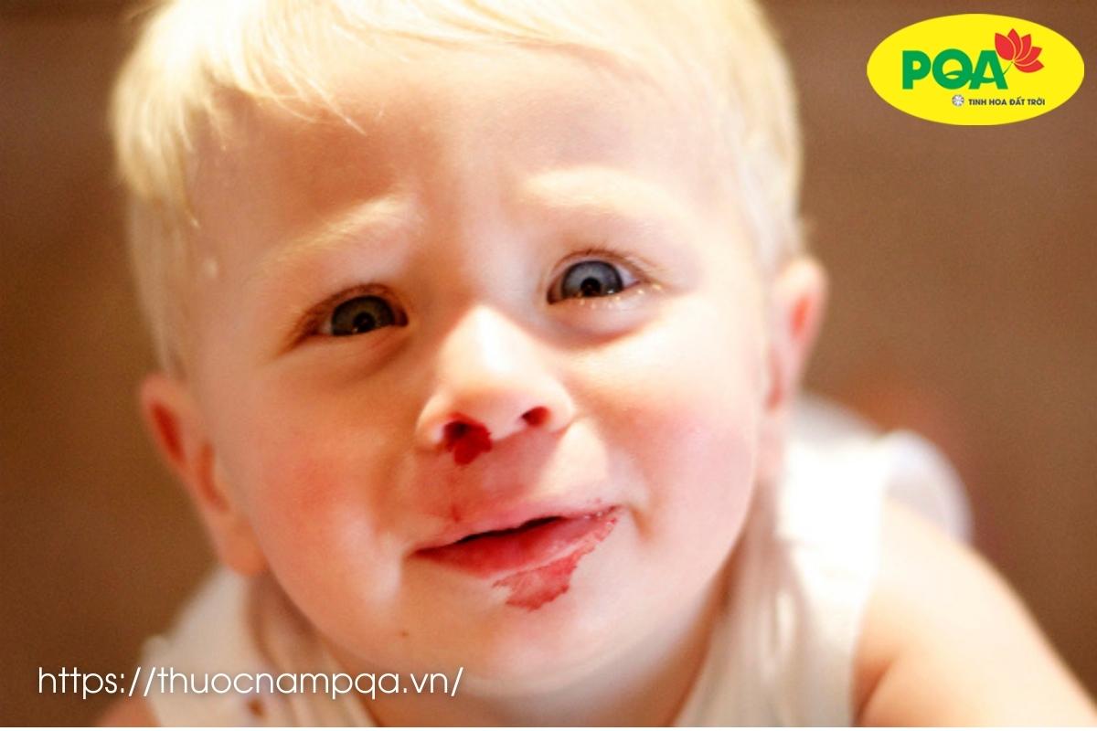 [Hỏi đáp] Trẻ 2 tuổi chảy máu cam phải làm gì?
