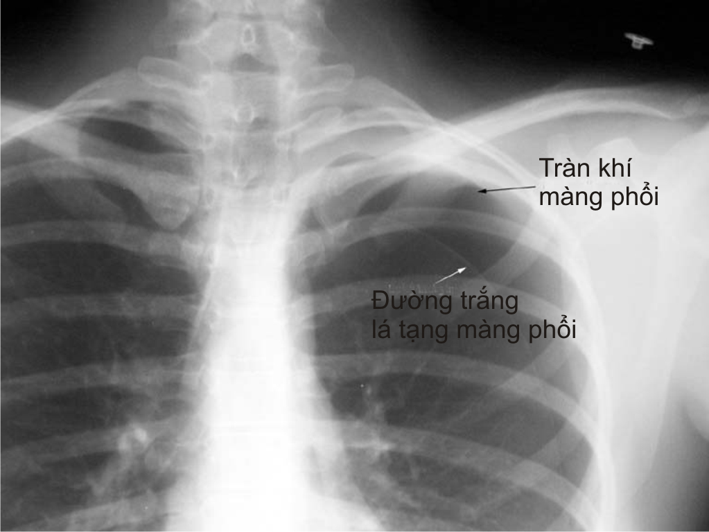 Tràn khí màng phổi biến chứng nguy hiểm của hen suyễn cần đặc biệt lưu tâm