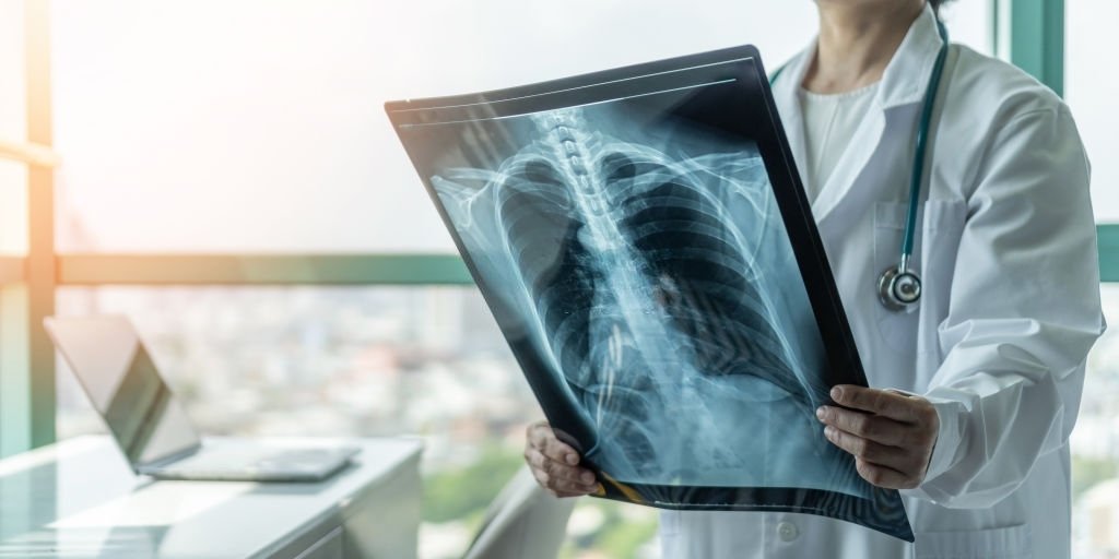 X quang COPD hỗ trợ chẩn đoán bệnh nhanh chóng, hiệu quả