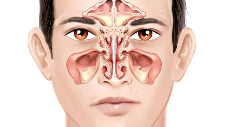 Bệnh viêm xoang là gì? Nguyên nhân, triệu chứng và cách phòng bệnh