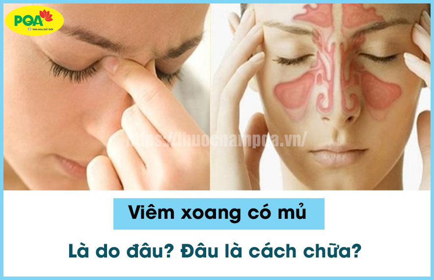 Cách chữa viêm xoang có mủ (hôi, xanh, có máu) hiệu quả nhất