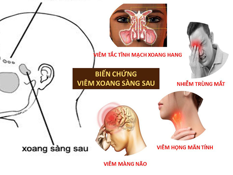 Viêm xoang sàng: Triệu chứng và cách điều trị được chuyên gia khuyên dùng