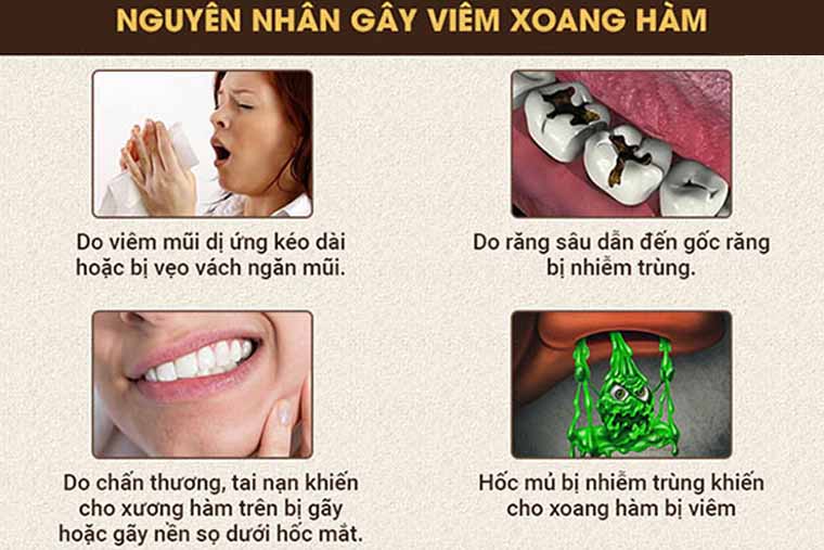 Viêm xoang hàm là gì? Các dấu hiệu nhận biết viêm xoang hàm