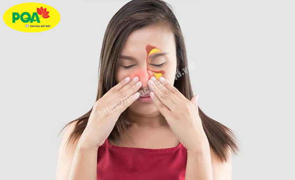 Viêm xoang có nguy hiểm không? Bật mí dứt điểm viêm xoang theo chuyên gia