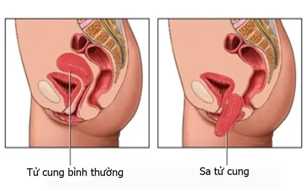 Bệnh sa tử cung sau sinh: Nguyên nhân và dấu hiệu nhận biết
