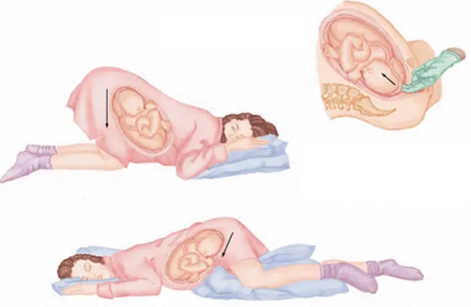 Sa tử cung khi mang thai và những nguy hiểm  khôn lường