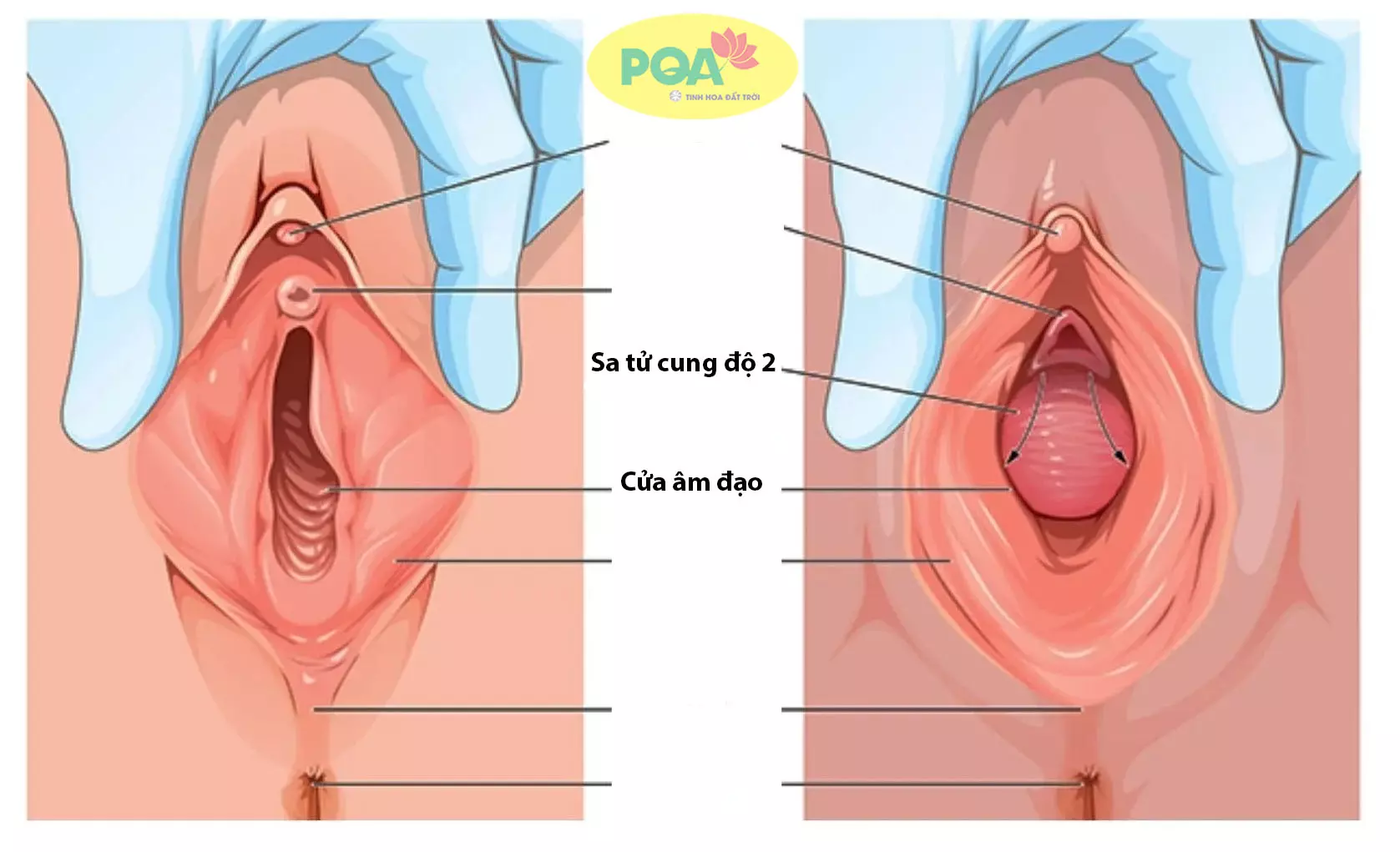 Sa tử cung độ 2 : Nhận biết và phương pháp điều trị hiệu quả